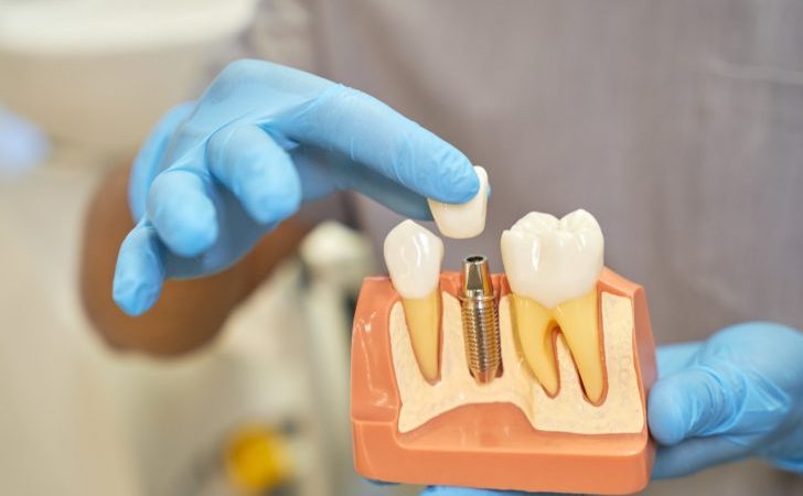 What are Dental Implants? Types and Treatment